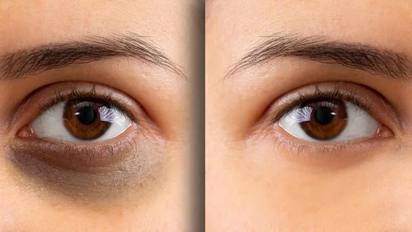Dark Circle Eye